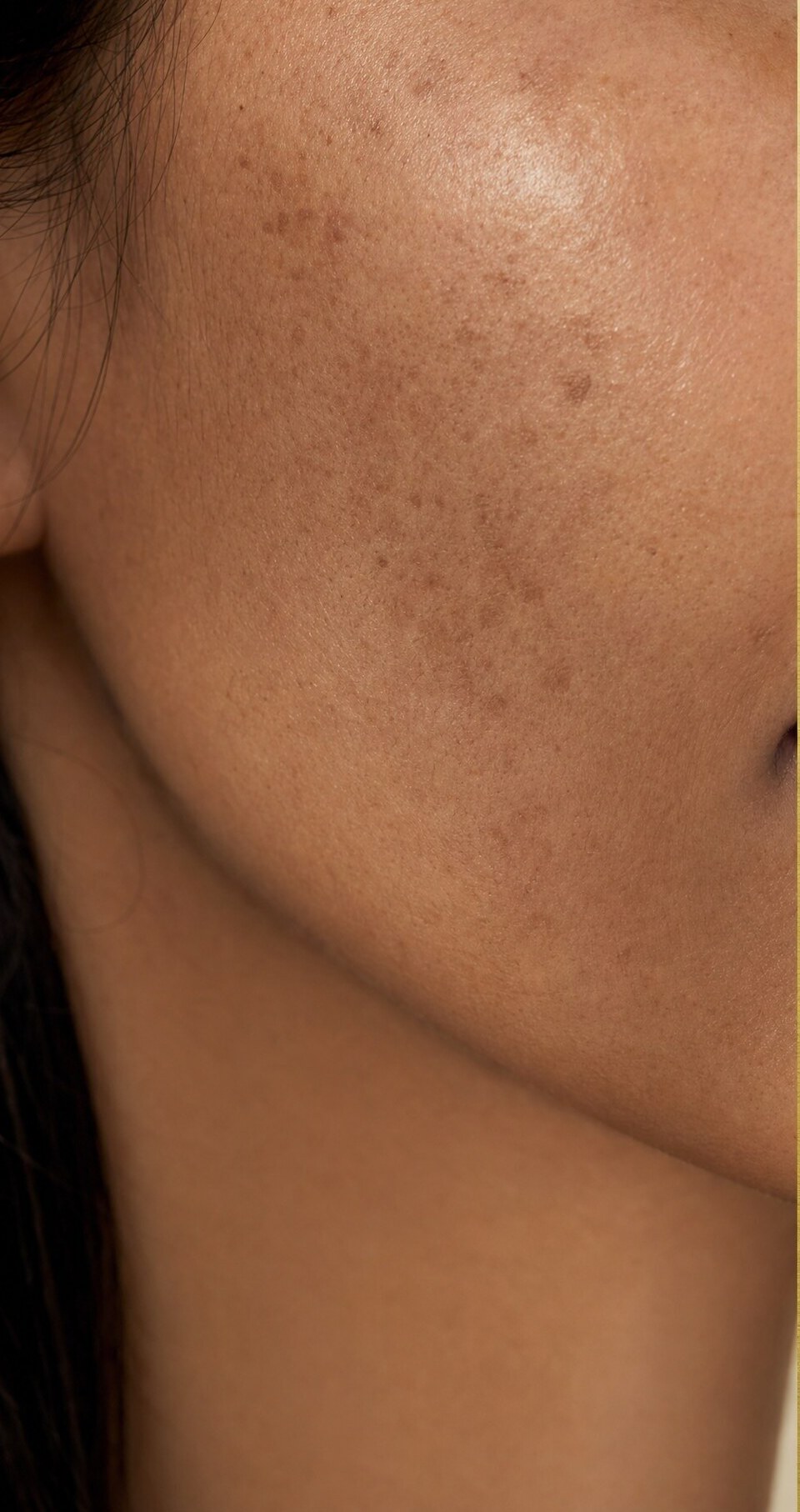 Redness and blemishes visibly reduced after 14 days — Before